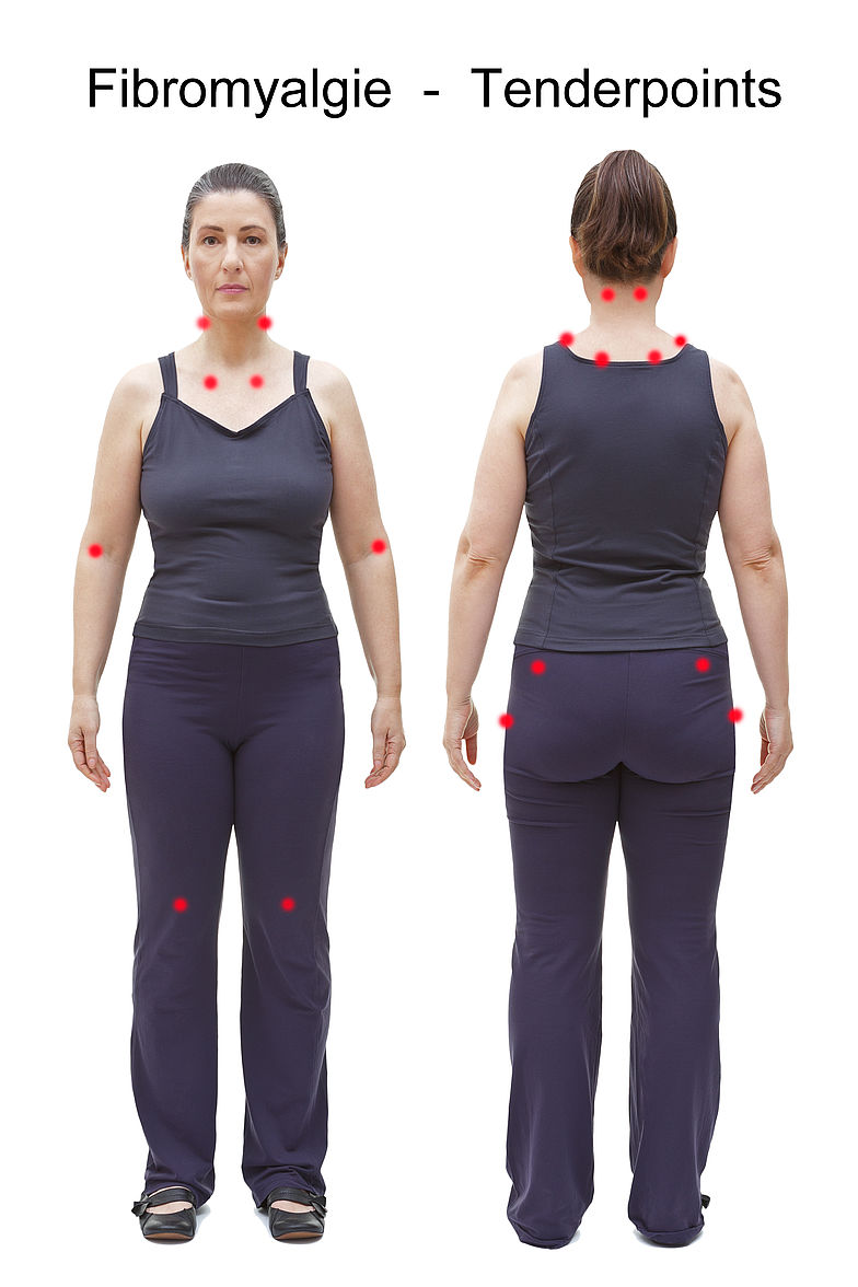 Schematische Darstellung der 18 Tenderpoints am Körper einer Frau. Bei 11+ schmerzhaften liegt eine Fibromyalgie vor.