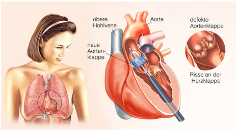 Schematische Darstellung der Anatomie des Herzens während des Einsetzens einer neuen Herzklappe.